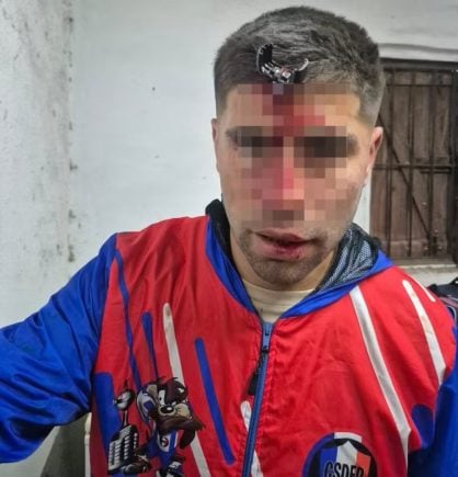 Chave De Carro É Cravada Na Testa De Jogador Após Briga 2